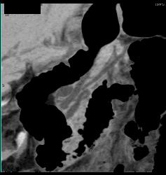 Pancreas Divisum of Miniip - CTisus CT Scan