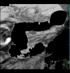 Pancreas Divisum of Miniip - CTisus CT Scan