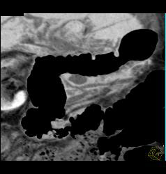 Pancreas Divisum of Miniip - Pancreas Case Studies - CTisus CT Scanning