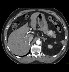 Metastatic Renal Cell Carcinoma Has Vascular Metastases - CTisus CT Scan