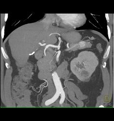 Metastatic Renal Cell Carcinoma Has Vascular Metastases - CTisus CT Scan