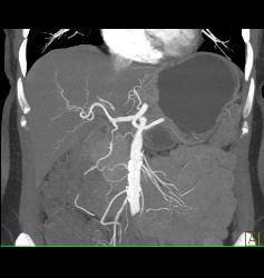 Pancreatic Cancer Encases PV/SMV/splenic Vein Confluence. Collateral Flow in Left Gonadal Vein - CTisus CT Scan