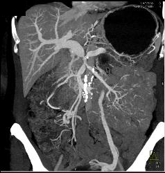 Pancreatic Cancer Encases PV/SMV/splenic Vein Confluence. Collateral Flow in Left Gonadal Vein - CTisus CT Scan