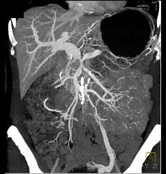 Pancreatic Cancer Encases PV/SMV/splenic Vein Confluence. Collateral Flow in Left Gonadal Vein - CTisus CT Scan