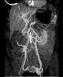 Pancreatic Cancer Encases PV/SMV/splenic Vein Confluence. Collateral Flow in Left Gonadal Vein - CTisus CT Scan