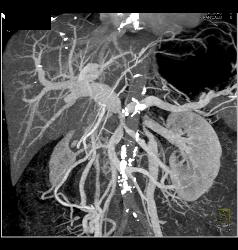 Pancreatic Cancer Encases PV/SMV/splenic Vein Confluence. Collateral Flow in Left Gonadal Vein - CTisus CT Scan