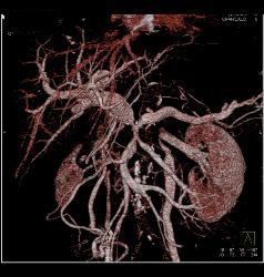 Pancreatic Cancer Encases PV/SMV/splenic Vein Confluence. Collateral Flow in Left Gonadal Vein - CTisus CT Scan