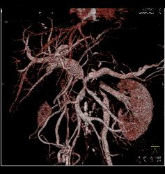 Pancreatic Cancer Encases PV/SMV/splenic Vein Confluence. Collateral Flow in Left Gonadal Vein - CTisus CT Scan