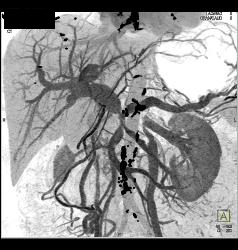 Pancreatic Cancer Encases PV/SMV/splenic Vein Confluence. Collateral Flow in Left Gonadal Vein - CTisus CT Scan