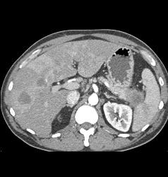 Carcinoma Tail of Pancreas With Liver Metastases - CTisus CT Scan