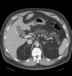 Fatty Infiltration of the Pancreas - CTisus CT Scan