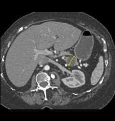 Intraductal Papillary Mucinous Neoplasm (IPMN) - CTisus CT Scan