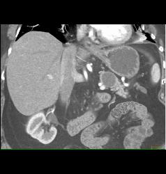 Intraductal Papillary Mucinous Neoplasm (IPMN) - CTisus CT Scan