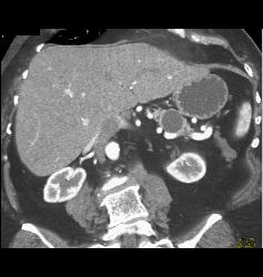 Intraductal Papillary Mucinous Neoplasm (IPMN) - CTisus CT Scan