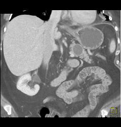 Intraductal Papillary Mucinous Neoplasm (IPMN) - CTisus CT Scan