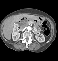 Intraductal Papillary Mucinous Neoplasm (IPMN) S/p Whipple Procedure With Dilated Pancreatic Duct - CTisus CT Scan