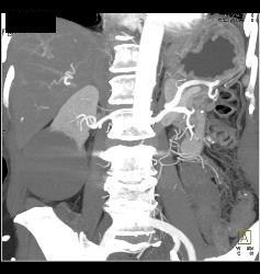 Intraductal Papillary Mucinous Neoplasm (IPMN) S/p Whipple Procedure With Dilated Pancreatic Duct - CTisus CT Scan