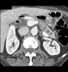 Intraductal Papillary Mucinous Neoplasm (IPMN) S/p Whipple Procedure With Dilated Pancreatic Duct - CTisus CT Scan