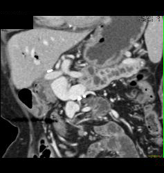 Intraductal Papillary Mucinous Neoplasm (IPMN) S/p Whipple Procedure With Dilated Pancreatic Duct - CTisus CT Scan