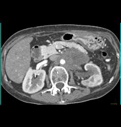 Neuroendocrine Tumor Encases the Aorta and Obstructs the Left Kidney - CTisus CT Scan