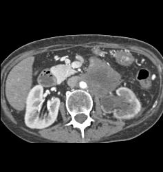 Neuroendocrine Tumor Encases the Aorta and Obstructs the Left Kidney - CTisus CT Scan