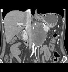 Neuroendocrine Tumor Encases the Aorta and Obstructs the Left Kidney - CTisus CT Scan