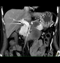 Neuroendocrine Tumor Encases the Aorta and Obstructs the Left Kidney - CTisus CT Scan