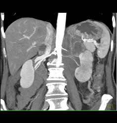 Neuroendocrine Tumor Encases the Aorta and Obstructs the Left Kidney - CTisus CT Scan