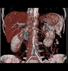 Neuroendocrine Tumor Encases the Aorta and Obstructs the Left Kidney - CTisus CT Scan