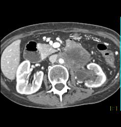 Neuroendocrine Tumor Encases the Aorta and Obstructs the Left Kidney - CTisus CT Scan