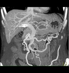 Neuroendocrine Tumor Encases the Aorta and Obstructs the Left Kidney - CTisus CT Scan