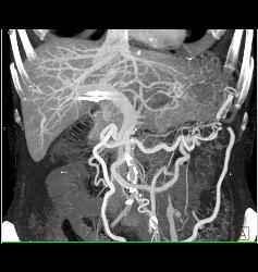 Neuroendocrine Tumor Encases the Aorta and Obstructs the Left Kidney - CTisus CT Scan