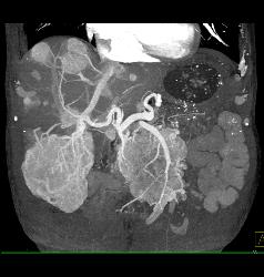 Islet Cell With Vascular Liver Metastases - CTisus CT Scan