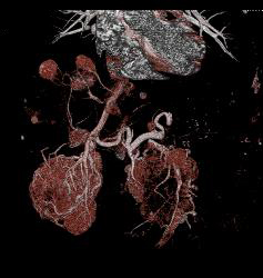 Islet Cell With Vascular Liver Metastases - CTisus CT Scan