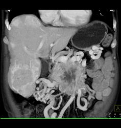 Islet Cell With Vascular Liver Metastases - CTisus CT Scan