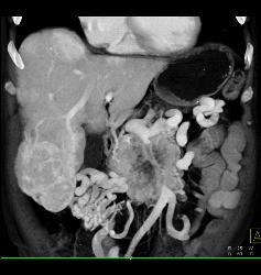 Islet Cell With Vascular Liver Metastases - CTisus CT Scan