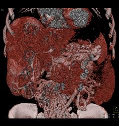 Islet Cell With Vascular Liver Metastases - CTisus CT Scan