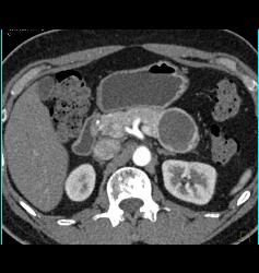 Cystic Islet Cell Tumor - CTisus CT Scan