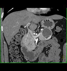 Cystic Islet Cell Tumor - CTisus CT Scan