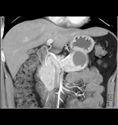 Cystic Islet Cell Tumor - CTisus CT Scan