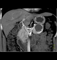 Cystic Islet Cell Tumor - CTisus CT Scan