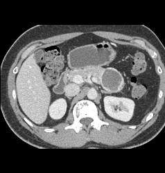 Cystic Islet Cell Tumor - CTisus CT Scan