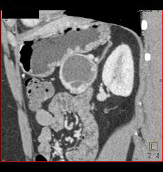 Cystic Islet Cell Tumor - CTisus CT Scan