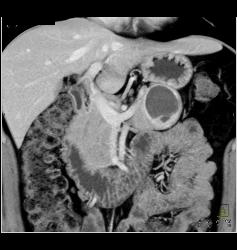 Cystic Islet Cell Tumor - CTisus CT Scan