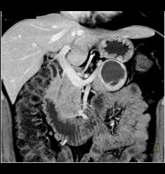 Cystic Islet Cell Tumor - CTisus CT Scan