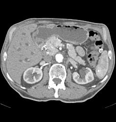 Unusual Islet Cell Tumor in Head of Pancreas - CTisus CT Scan