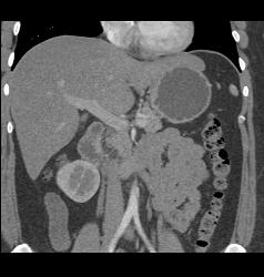 Unusual Islet Cell Tumor in Head of Pancreas - CTisus CT Scan