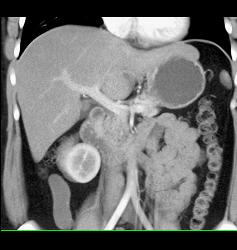 Unusual Islet Cell Tumor in Head of Pancreas - CTisus CT Scan