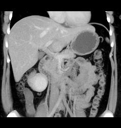 Unusual Islet Cell Tumor in Head of Pancreas - CTisus CT Scan