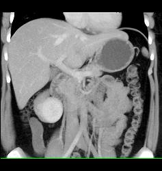 Unusual Islet Cell Tumor in Head of Pancreas - CTisus CT Scan